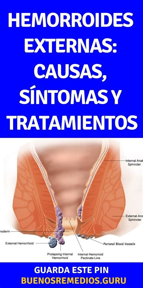 hemorroides externas fotos y videos|Hemorroides Externas: Causas y Tratamientos Efectivos